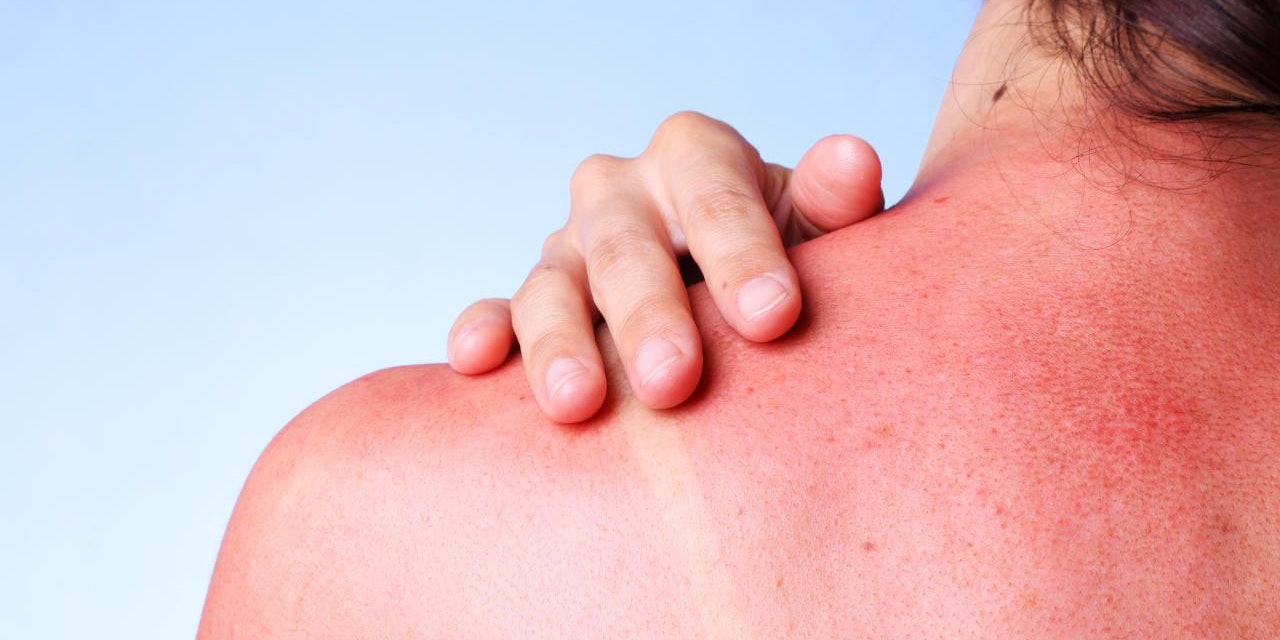 Mit jedem Sommer ist er bei den meisten zurück: Der Sonnenbrand. Wie man ihn behandeln kann, zeigen wir hier! 