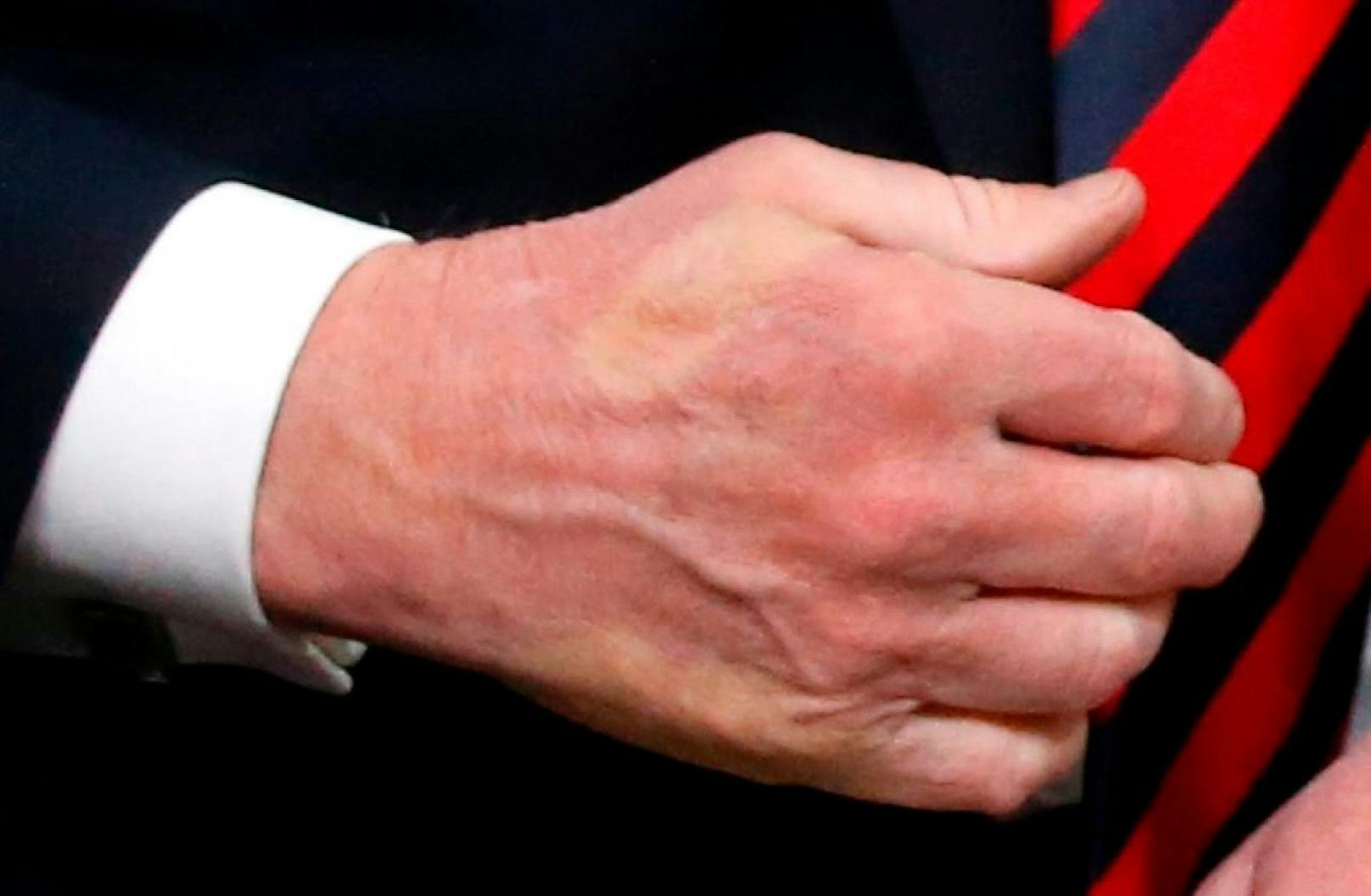 Der Beweis: Macron hat Trump so stark die Hand geschüttelt, dass der Abdruck seines Daumens zurückblieb.  
