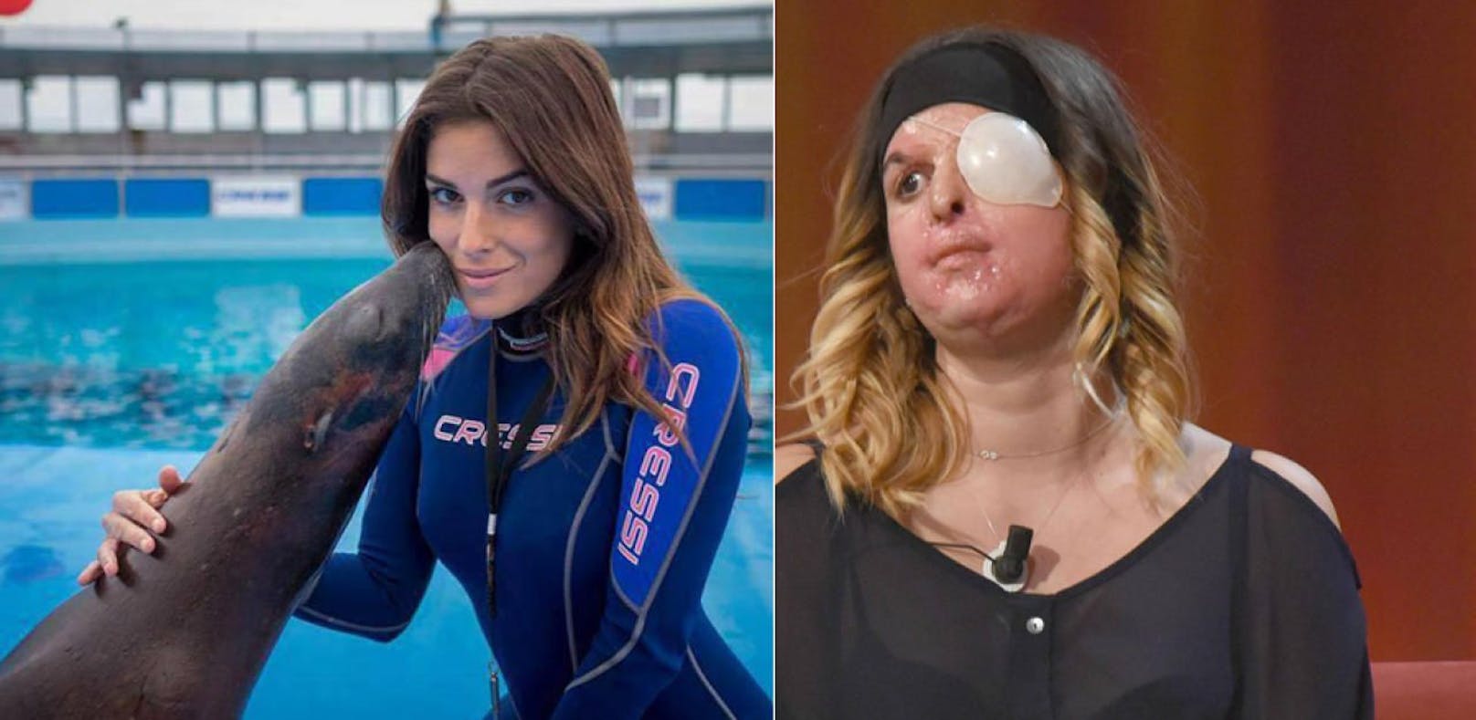 Säureanschlag: Ex-Miss zeigt erstmals ihr Gesicht