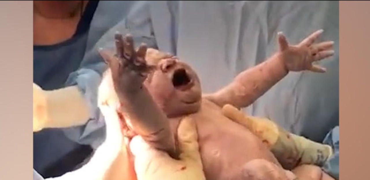 Heute.at - Hebamme zieht ihr Kind selbst aus dem Bauch