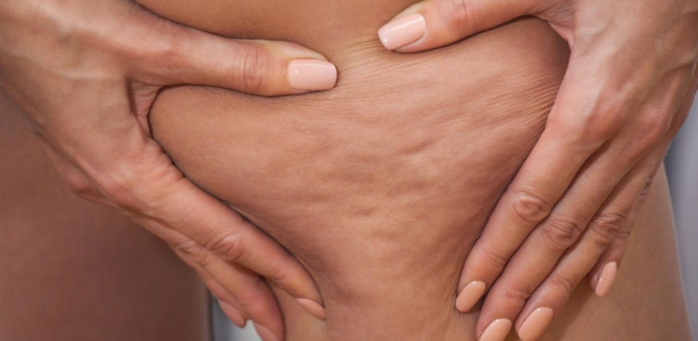 Cellulite, auch "Orangenhaut" genannt