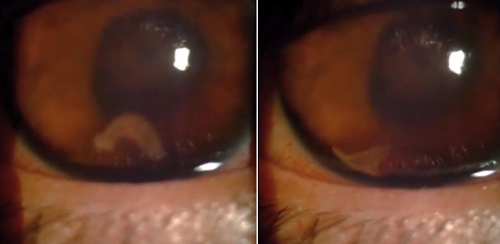 Der Parasit hat die Netzhaut des Jugendlichen stark beschädigt