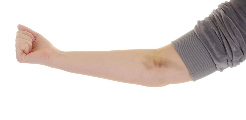 Der Helfer wurde von dem 39-Jährigen in den Arm gebissen