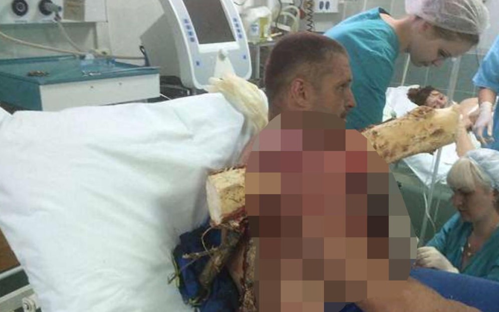 Unfassbar: Ein Ast hatte Paragleiter Ivan K. (36) aufgespießt, doch der Sportler machte im Spital noch Witze. Ärzte entfernten den Fremdkörper in einer OP. 