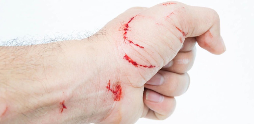 Die Frauen erlitten Kratzwunden.