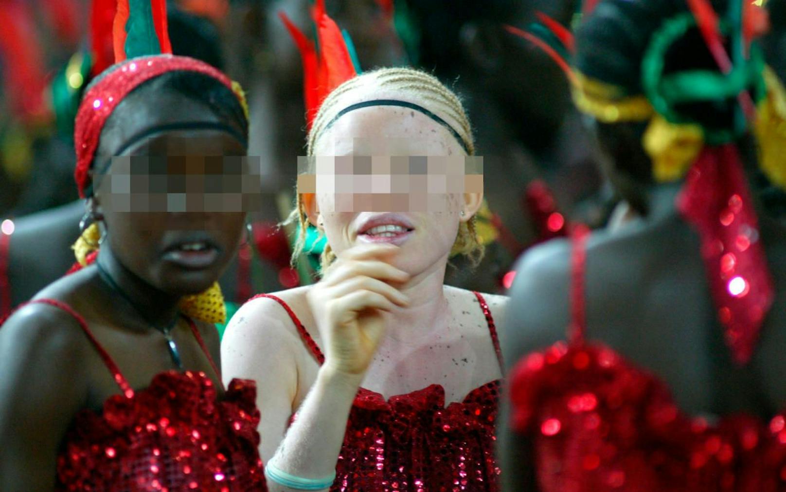 Ein Albinomädchen bei einer Feier in Nigeria. Symbolfoto