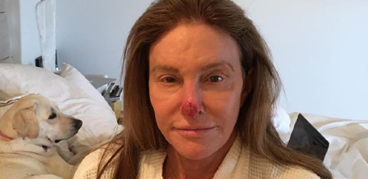 Heute.at - Caitlyn Jenner erklärt, was mit ihrer Nase los ist