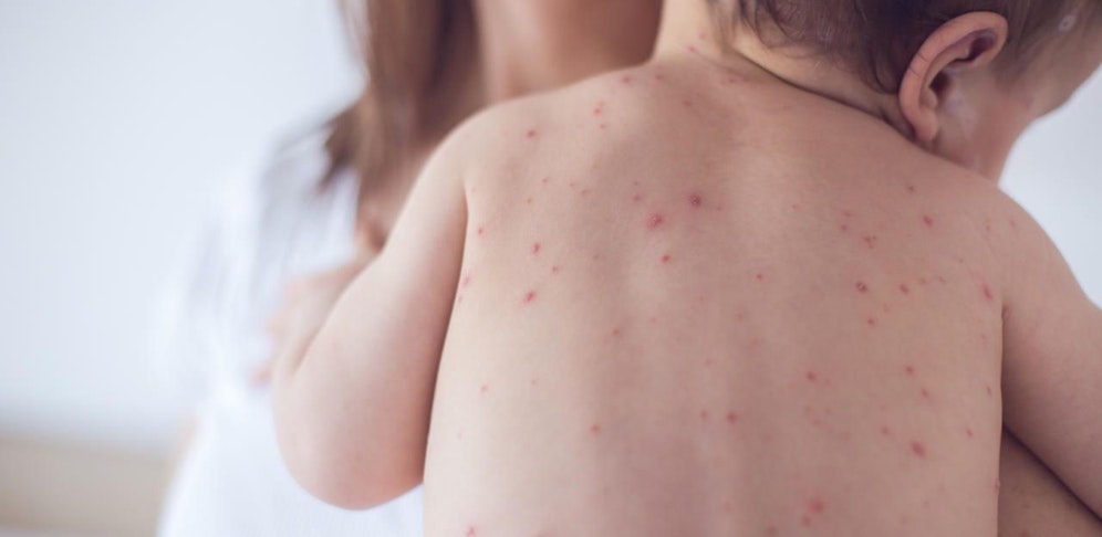 Die Ärztekammer fordert eine Masern-Impfpflicht und appelliert an die zukünftige Regierung