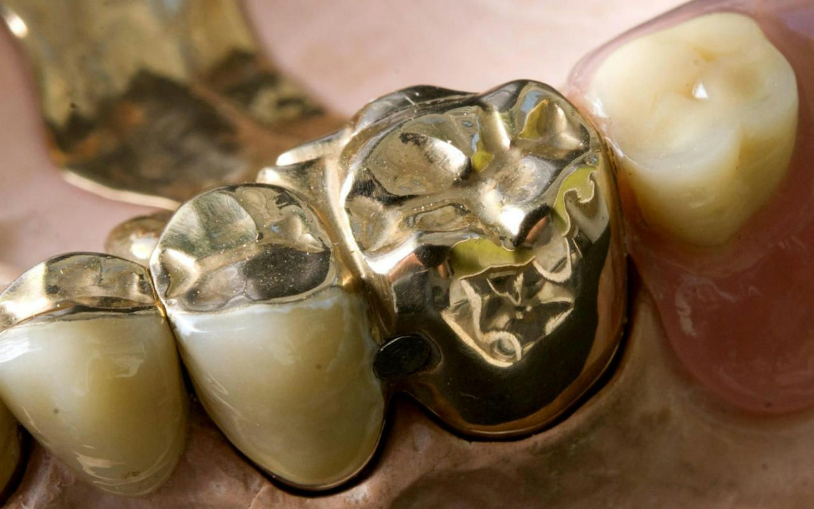 Eine Zahnprothese, die zum Teil aus Gold besteht, steckt im Modell eines Unterkiefers.