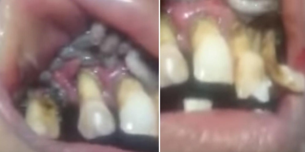 Im Mund der Frau hatten sich unzählige Maden eingenistet