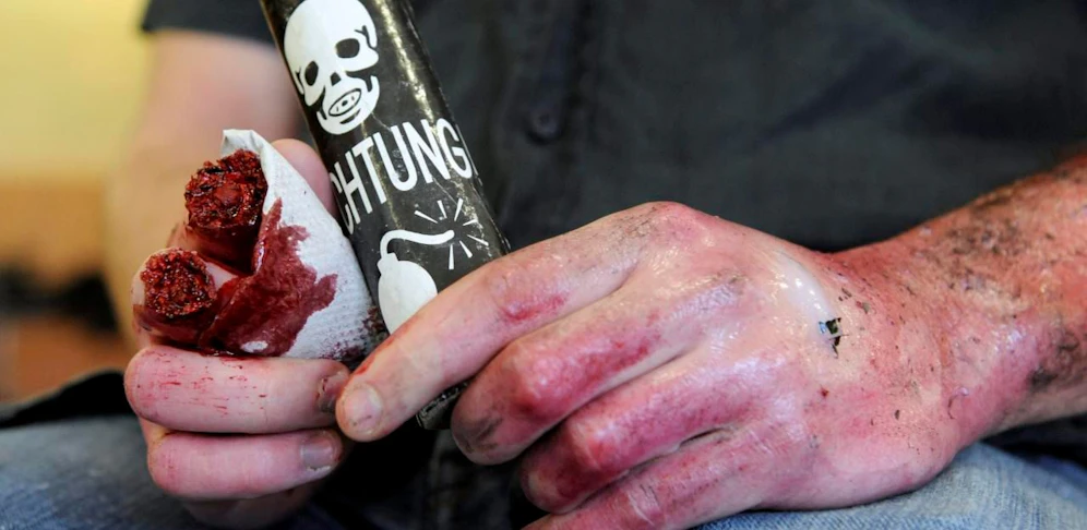 Nachgestelltes Bild: So können Verletzungen durch Böller aussehen.