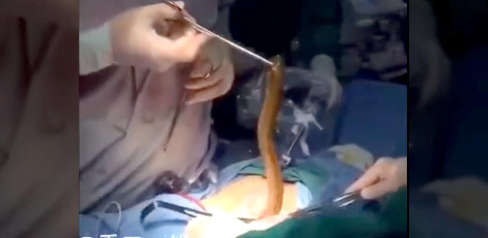 Ekel-Video: Aal aus Magen eines Mannes operiert