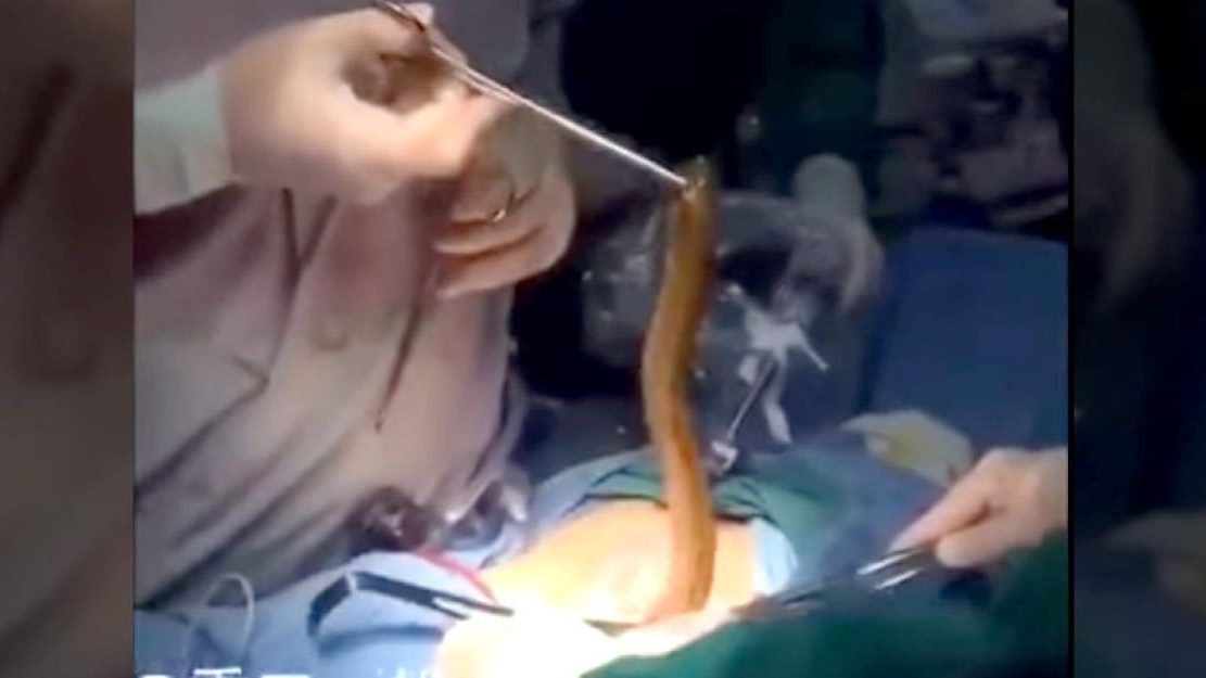 Heute.at - Ekel-Video: Aal aus Magen eines Mannes operiert