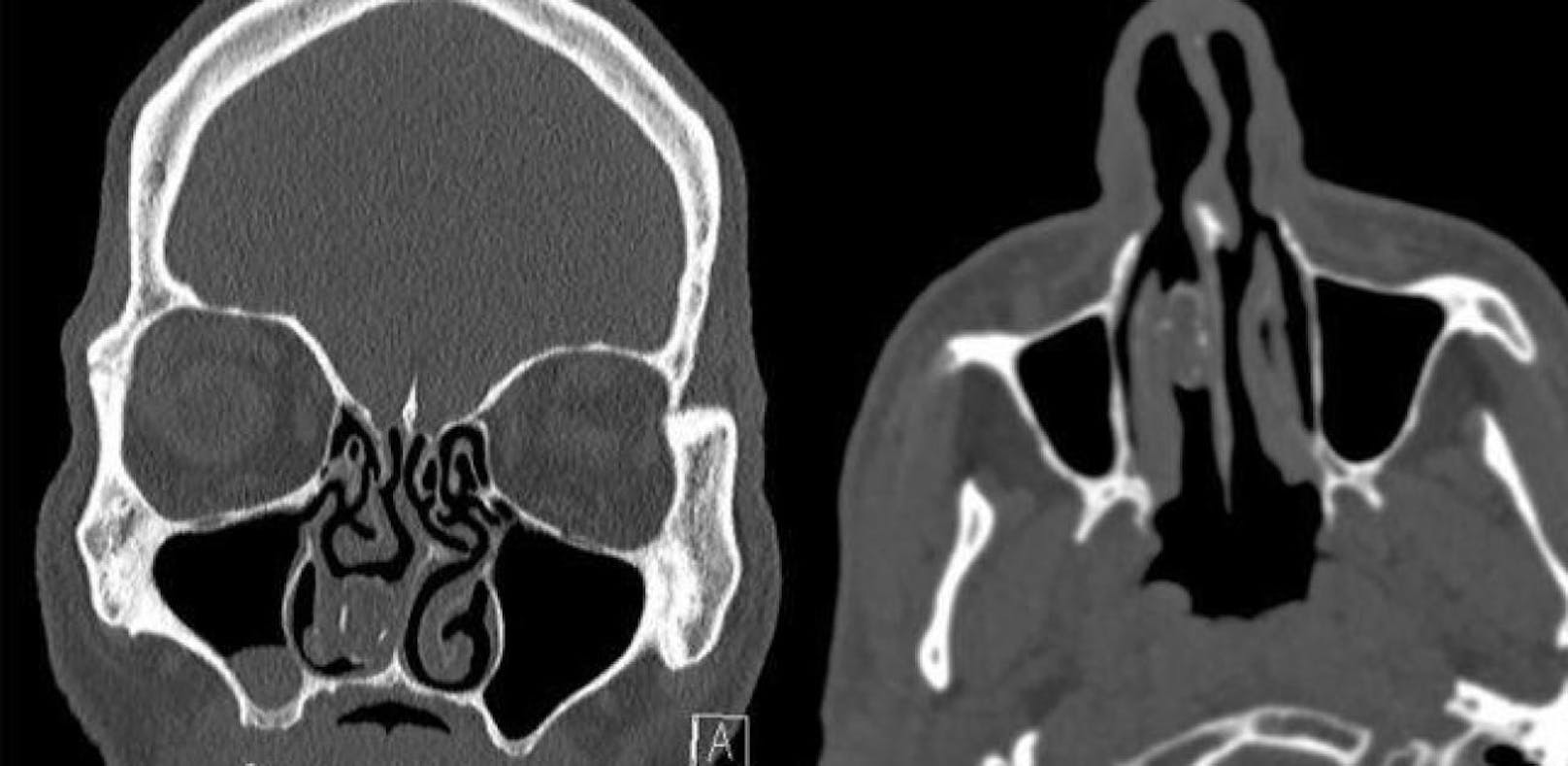 Nach 18 Jahren war aus dem Drogenpäckchen, das sich ein Australier in die Nase gesteckt hatte, ein Rhinolith, also ein Nasenstein geworden. Er ist auf dem CT-Scan im rechten Nasenloch (auf der Aufnahme links) zu sehen.
