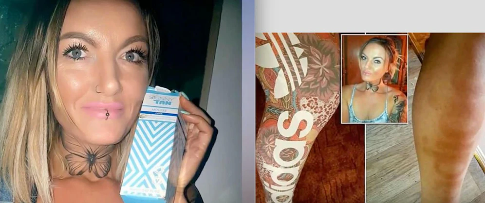 Markenbotschafterin? Nein, Kosmetikerin Kimberly D. (36) "brannte" sich unfreiwillig den Adidas-Schriftzug an die Wade. 