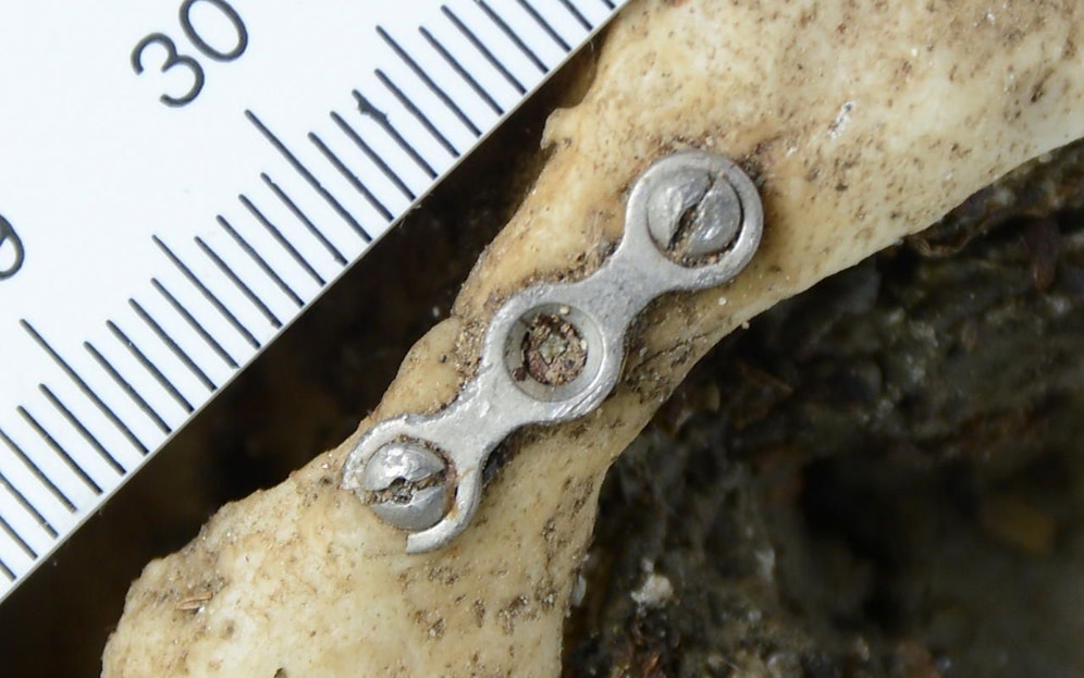 Wer kann Angaben zu einem Vermissten mit dieser Augenhöhlenoperation machen?