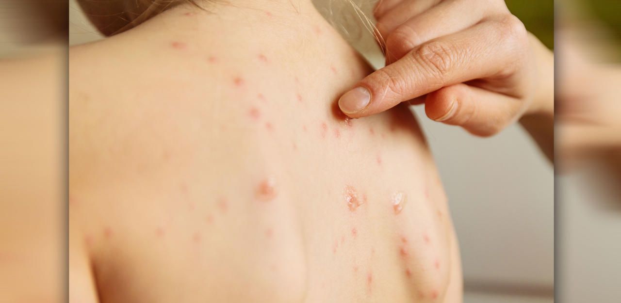 Heute.at - Masern-Epidemie in Serbien: Bereits 13 Tote