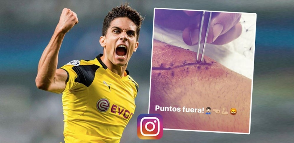 Dortmunds Marc Bartra zeigt seine Narbe.