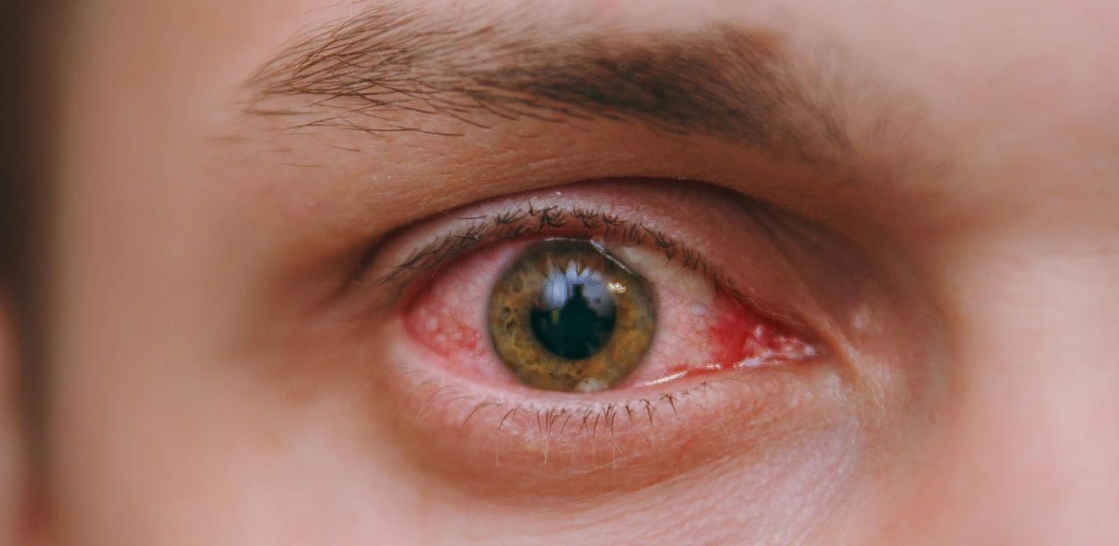 Bei der Augengrippe handelt es sich um eine Bindehautentzündung.
