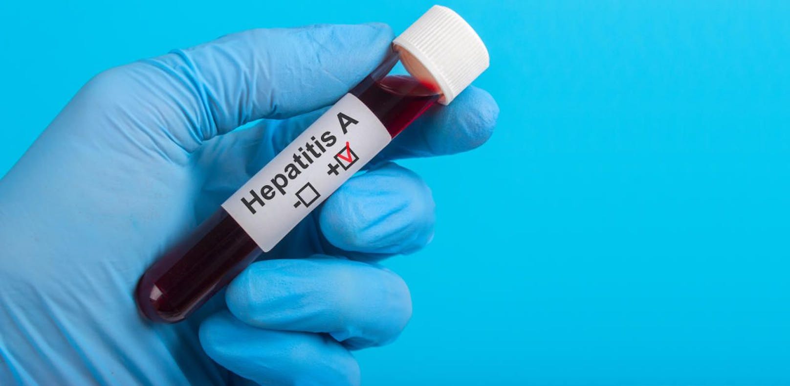 Hepatitis-A-Fälle steigen rasant an.