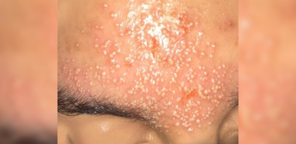 Die Folgen der Waxing-Behandlung.