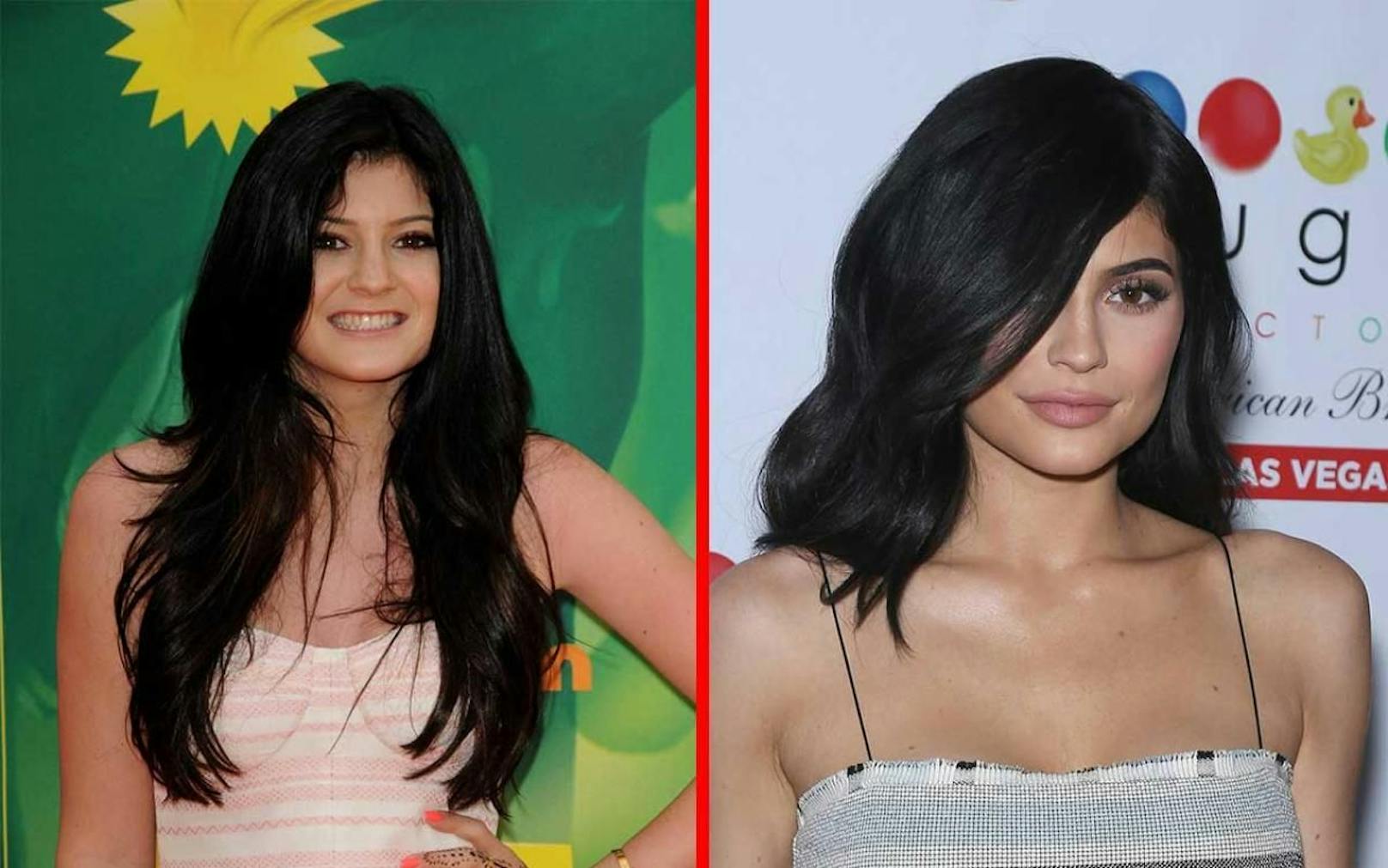 Kylie Jenner löste mit ihrer Lippen-Transformation einen Boom in der Schönheitschirurgie aus. Doch nicht alle Patienten wissen wann genug ist. 