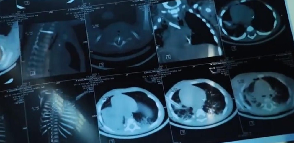 16 Nadeln im Körper eines Babys gefunden