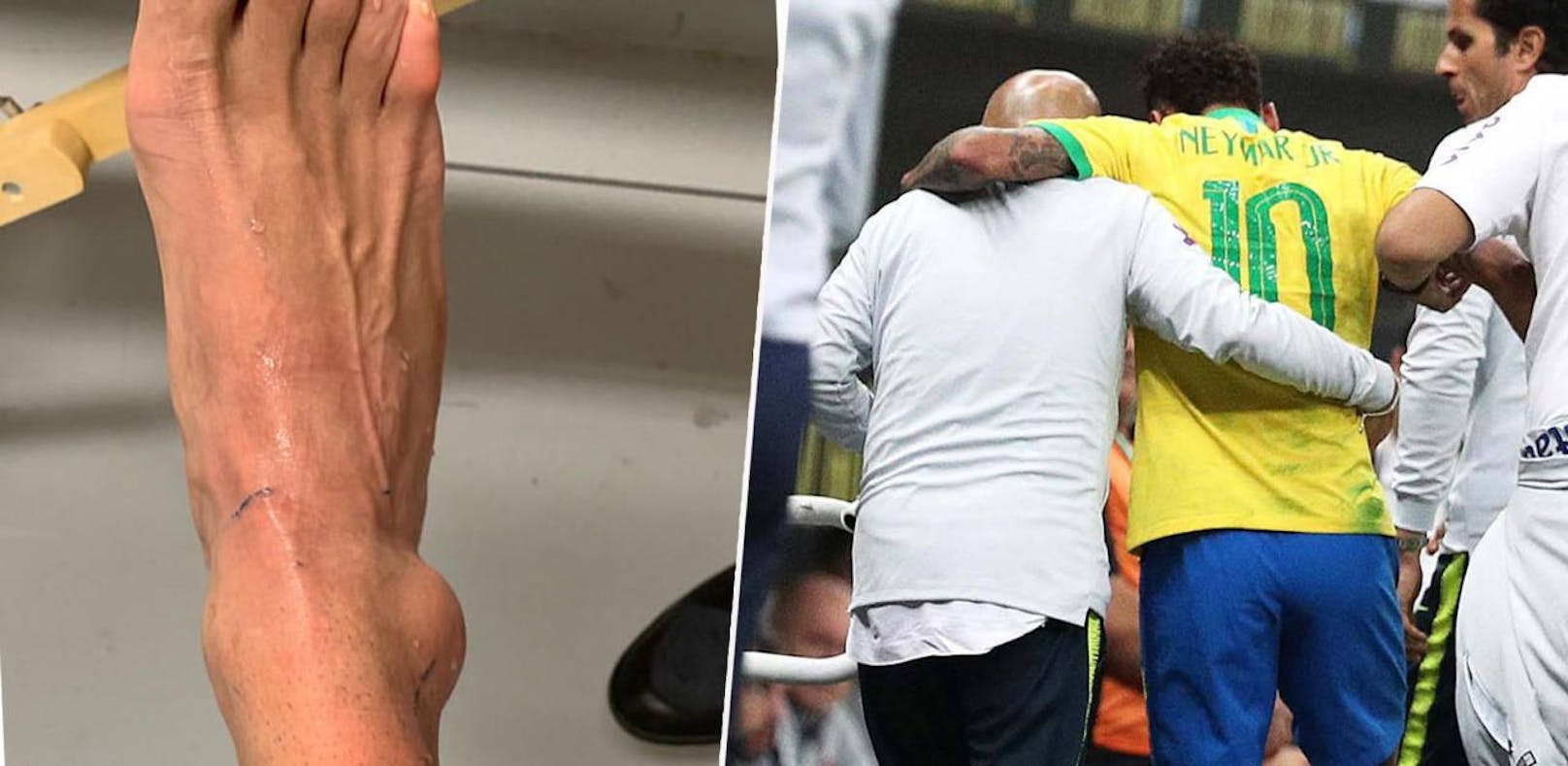 Neymar zeigt seine Verletzung auf Instagram.