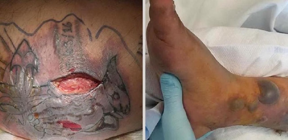 Bakterien fraßen sich in seinen Körper. Er starb an Organversagen.