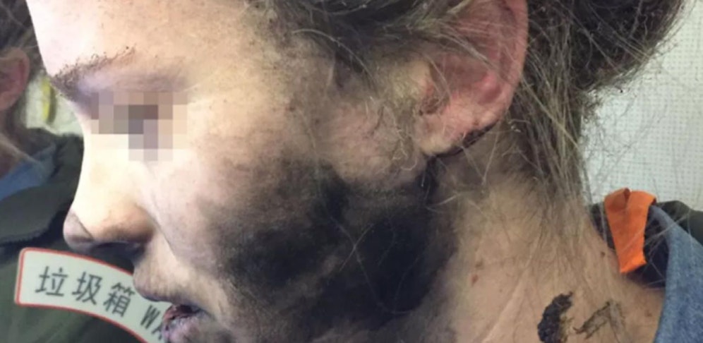 Die verletzte Frau nach dem Vorfall.