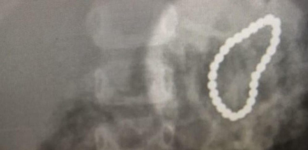 Eine Zweijährige hatte 28 Magnete verschluckt.