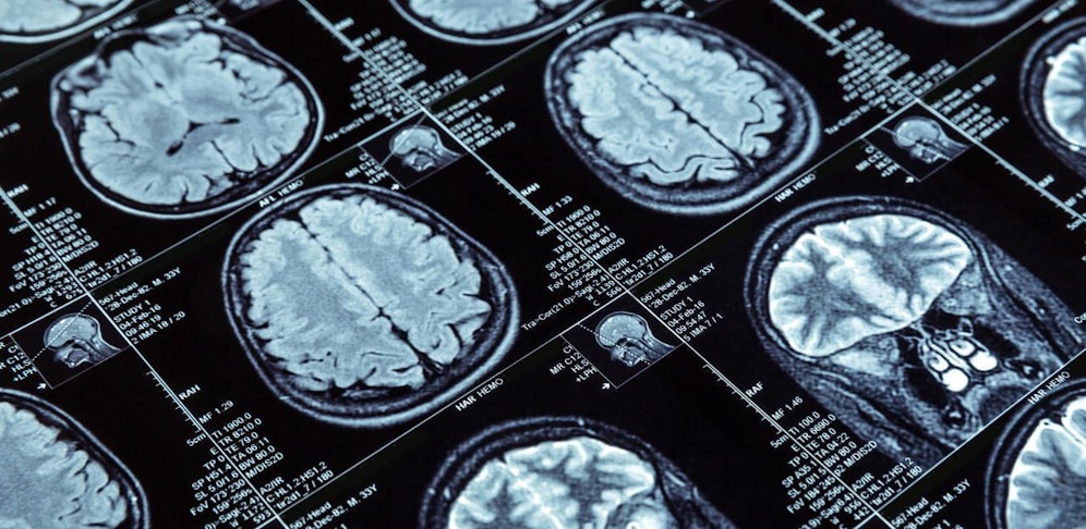 Der Parasit kann sich ins Gehirn fressen.