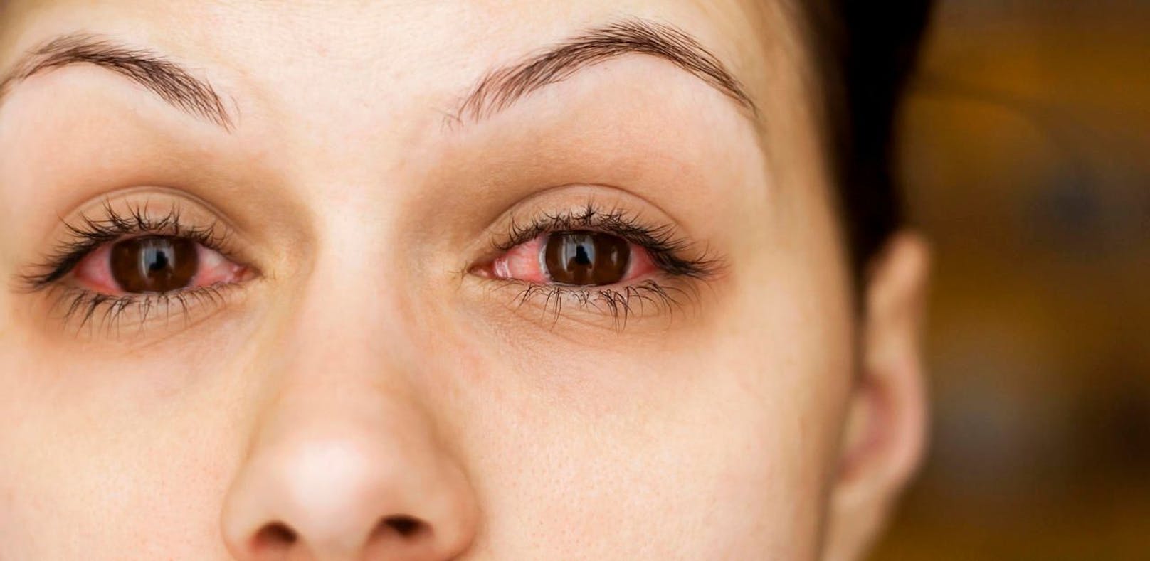 Augengrippe sollten Sie nicht mit Kamillentee behandeln.