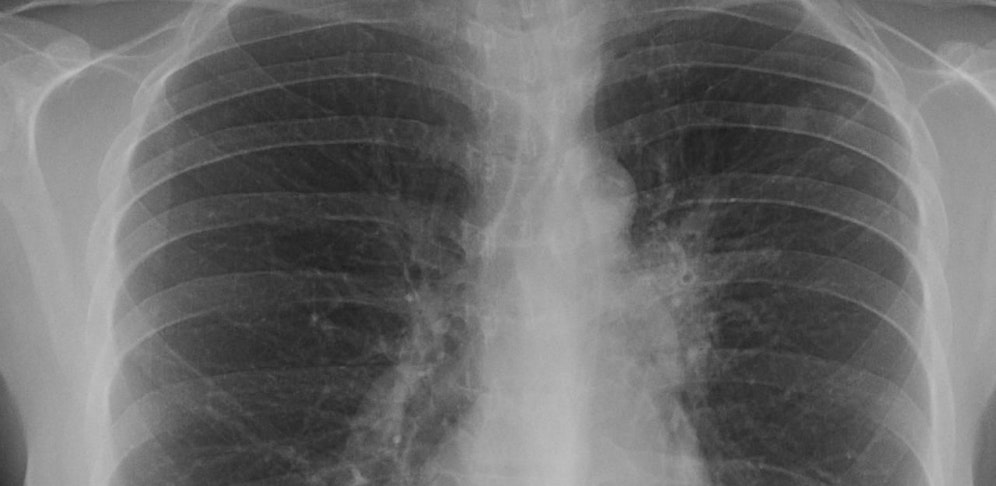 Tuberkulose-Fall in Purkersdorf: Jetzt kommt der nö. Röntgenbus.