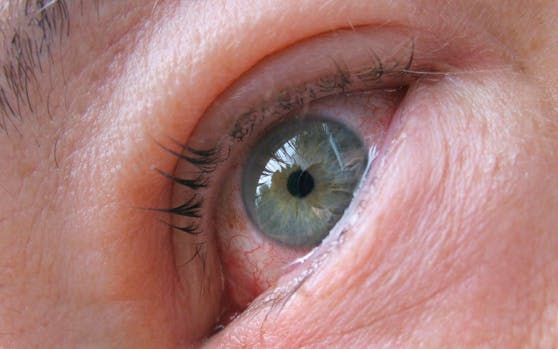 Experten befürchten, dass der Coronavirus auch rote Augen und Tränenfluss verursachen kann. Diese Symptome seien allerdings sehr selten.