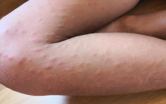 Die Kinder sind nach dem Baden mit Pusteln überzogen.