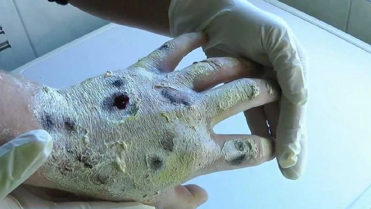 Welt Todesdroge Krokodil Geht Um Die Welt Heute at welt-todesdroge-krokodil-geht-um-die-welt-heute-at