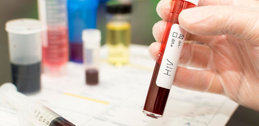 Zurzeit stecken sich täglich rund 5000 Personen mit dem HI-Virus an. Das macht etwa 1,8 Millionen Neuinfektionen pro Jahr. Ist bald Schluss damit?
