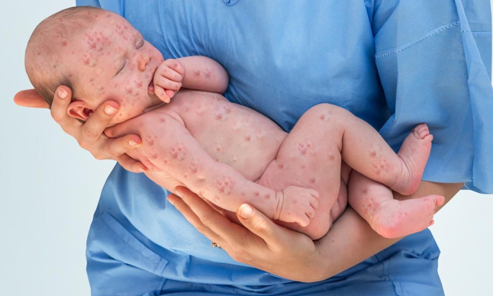 Die Masern sind in Österreich auf dem Vormarsch.