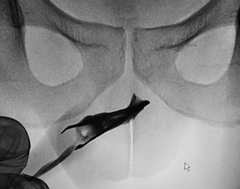 Nur auf den ersten Blick ist dies ein gewöhnliches Röntgenbild. Denn es zeigt eine Pinzette, die in der Harnröhre eines 22-Jährigen steckt. Der hatte den Greifer vier Jahre zuvor dort selbst hineingeschoben.