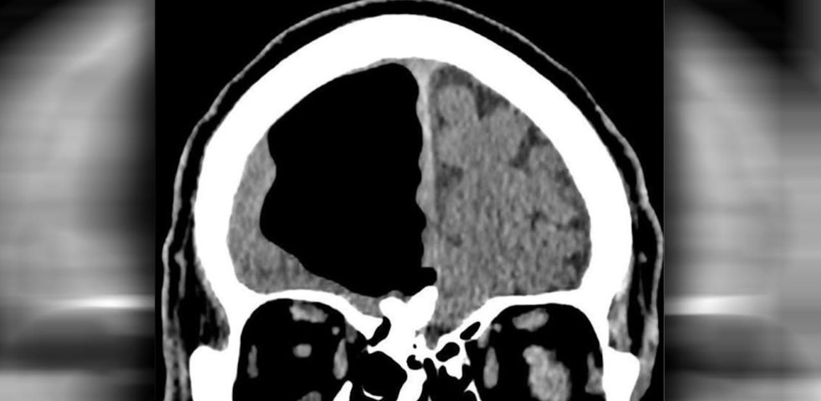 Mann niest zu heftig: Riesiges Loch im Gehirn
