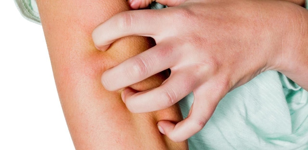 Der Ausschlag juckt und ist ansteckend.