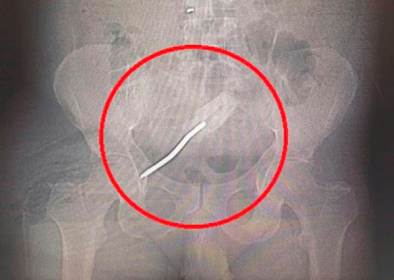 Der Patient hatte einen 21 Zentimeter langen Schraubenzieher in den Eingeweiden stecken.