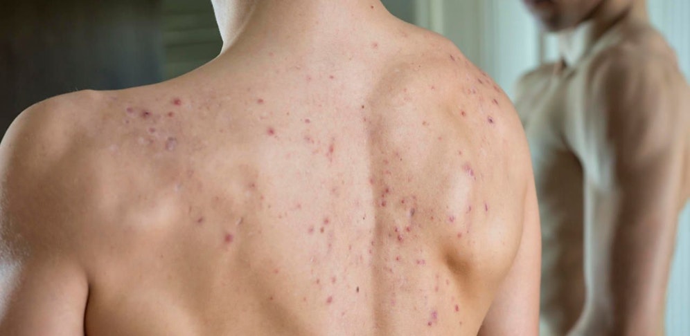 Akne auf dem Rücken eines jungen Mannes. Symbolfoto.