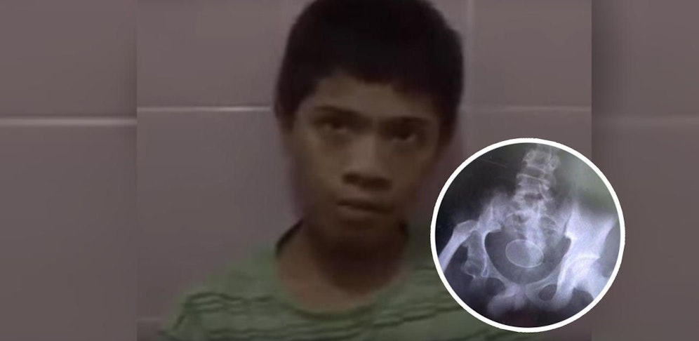 Das Röntgenbild zeigt das Ei im Körper des Buben.