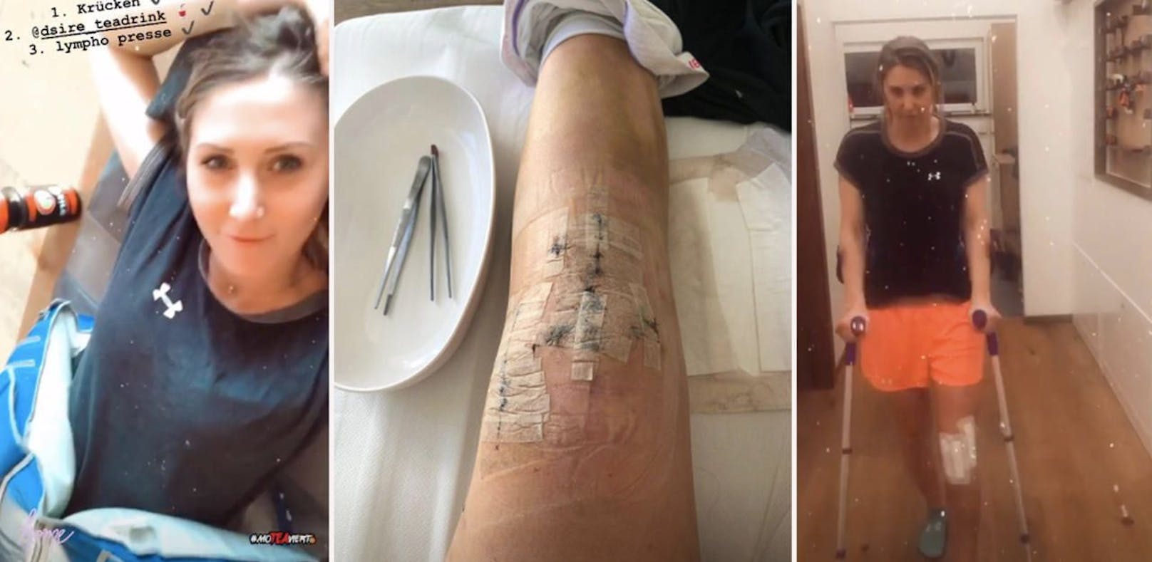 Conny Hütter zeigt ihre Reha-Fortschritte nach der Kreuzband-Operation in ihrer Instagram-Story.
