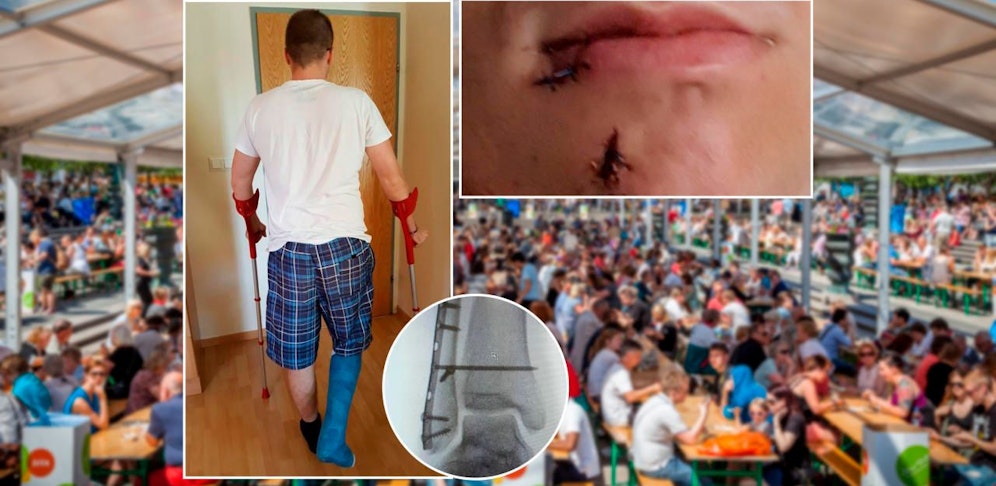 Der Burgenländer Philipp (23) wurde bei einem Zeltfest in Purbach übel zugerichtet. Folge: Beinfraktur, Nähte im Gesicht und wochenlang Liegegips