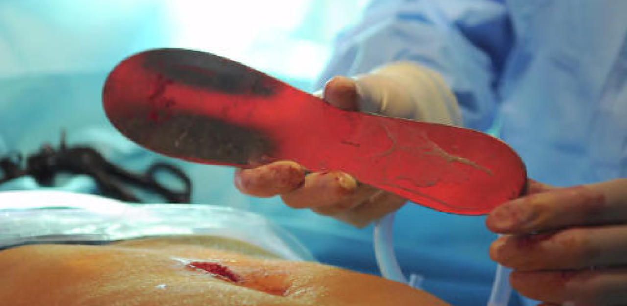 Heute.at - Ärzte vergessen Metall-Platte in Patientin