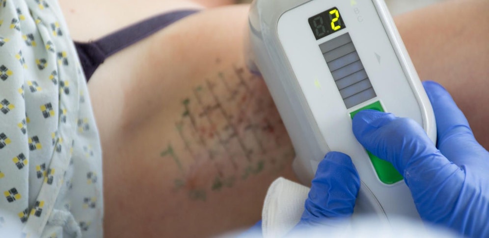 Mit Mikrowellen werden die Schweißdrüsen eliminiert.