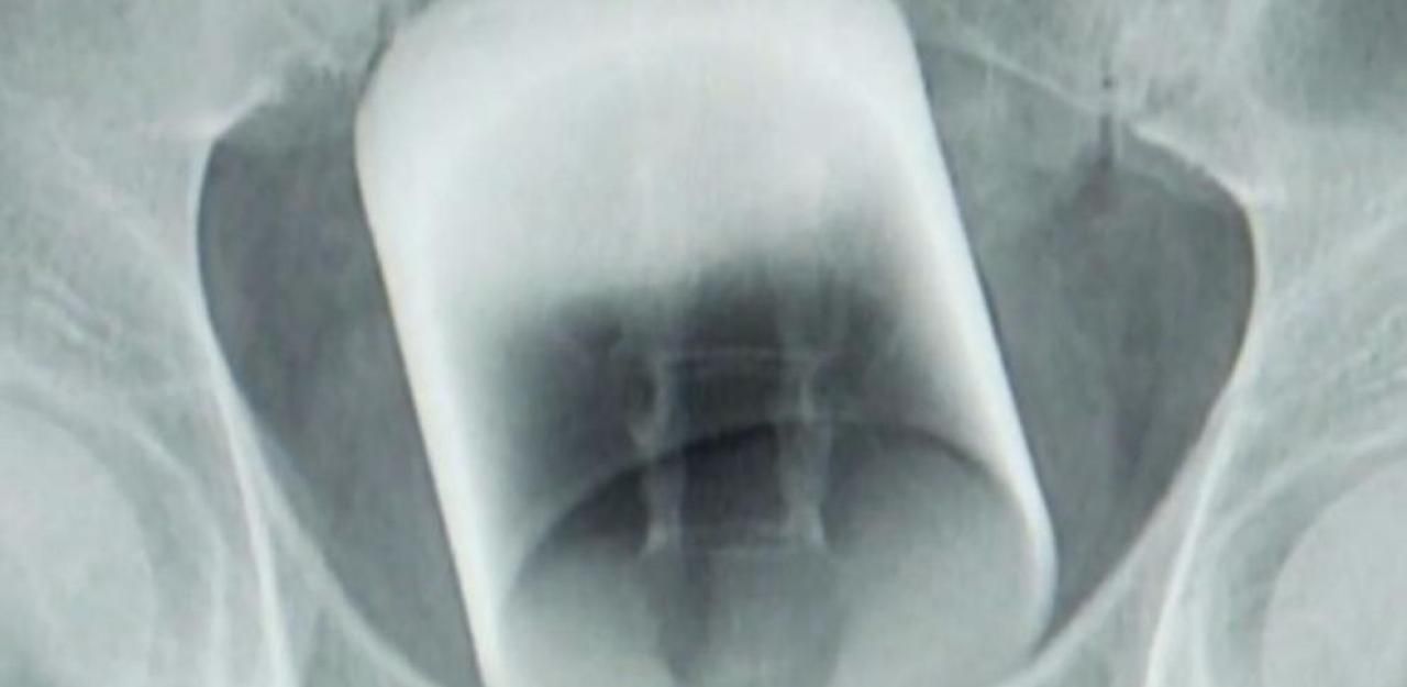 Heute.at - Ärzte finden 7-cm-Glas in Patienten-Po